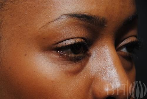 Eyelid Surgery Before & After