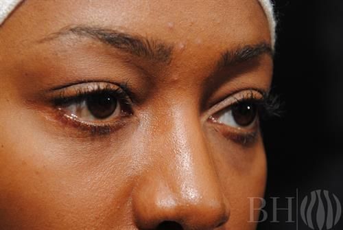 Eyelid Surgery Before & After