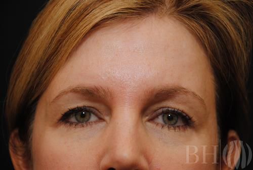 Eyelid Surgery Before & After