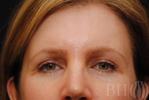 Eyelid Surgery Before & After