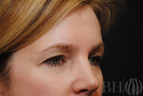 Eyelid Surgery Before & After