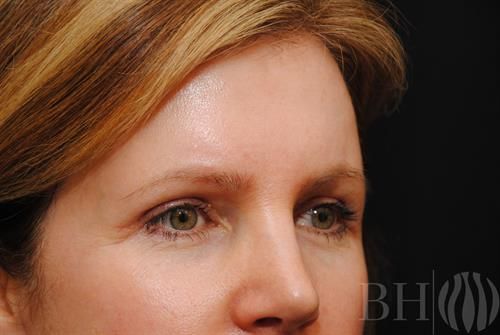 Eyelid Surgery Before & After