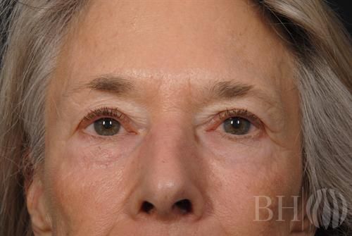 Eyelid Surgery Before & After