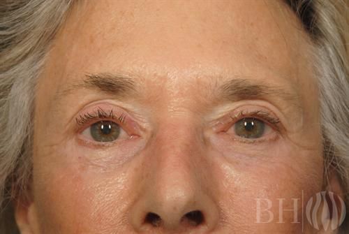 Eyelid Surgery Before & After