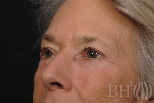 Eyelid Surgery Before & After