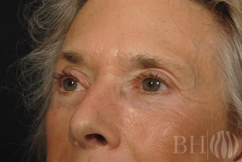 Eyelid Surgery Before & After