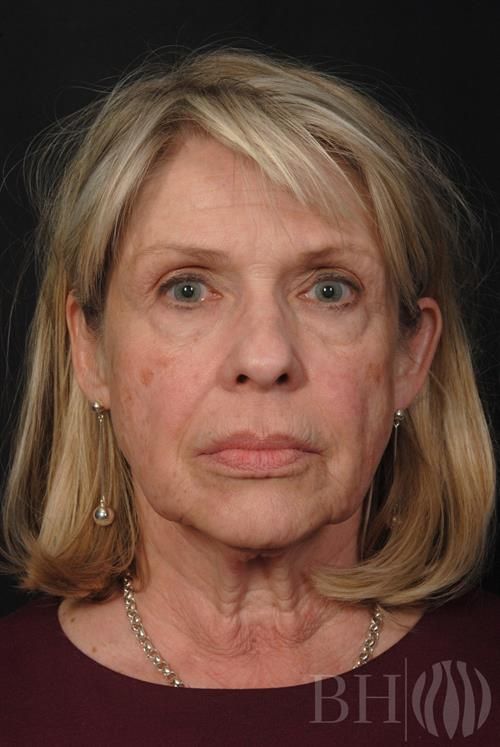 Eyelid Surgery Before & After