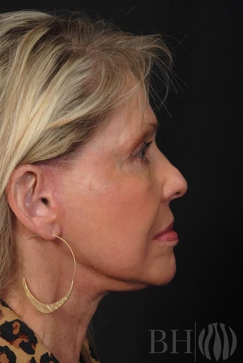 Eyelid Surgery Before & After