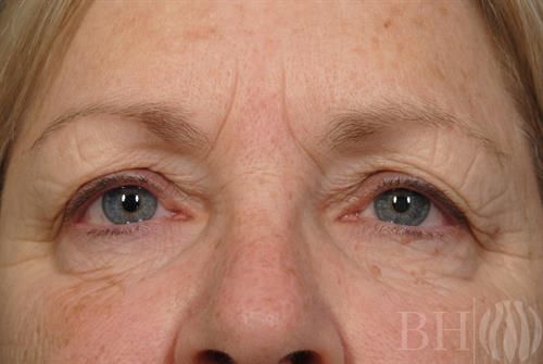 Eyelid Surgery Before & After