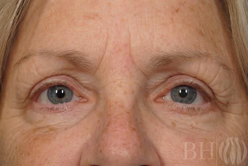 Eyelid Surgery Before & After