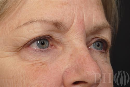 Eyelid Surgery Before & After
