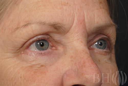 Eyelid Surgery Before & After
