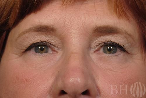 Eyelid Surgery Before & After