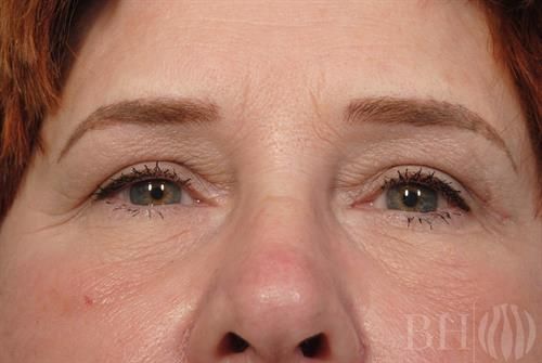 Eyelid Surgery Before & After