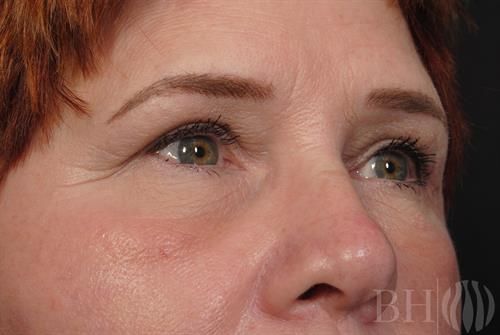 Eyelid Surgery Before & After